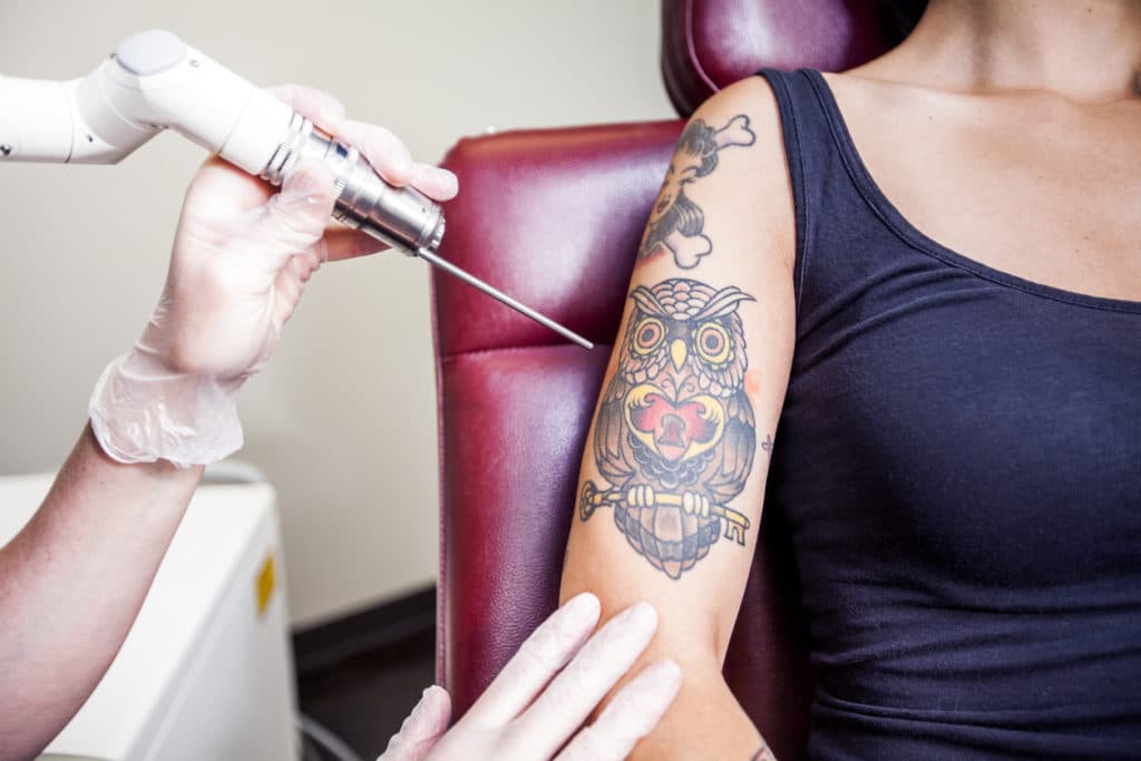 Person getting laser tattoo removal in Boca Raton
