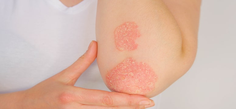 psoriasis on the elbow