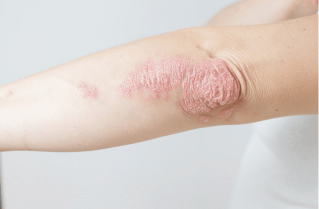 Acute psoriasis on elbows is an autoimmune incurable dermatological skin disease.