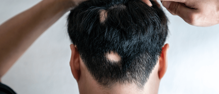 Asian guy point his hair loss