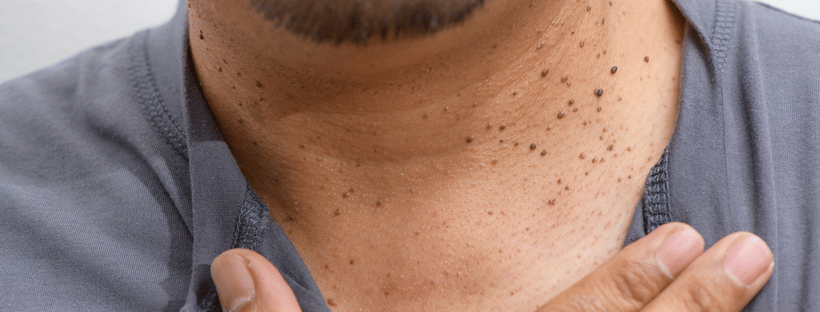 Skin Tags or Acrochordon on neck man on white background